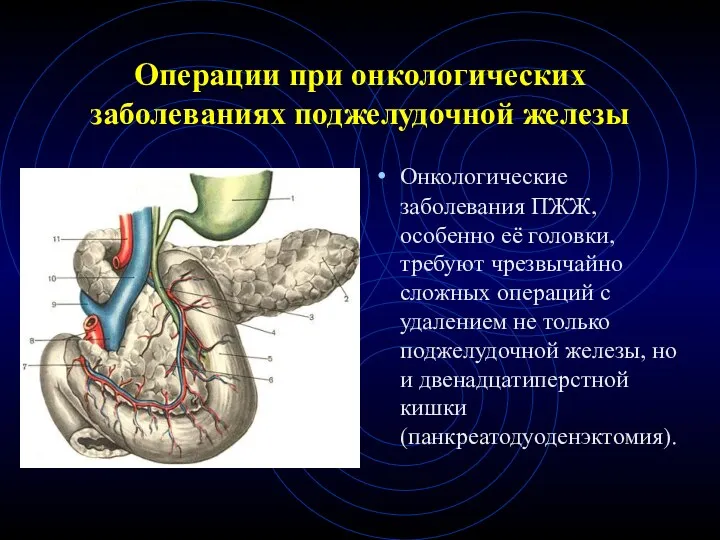 Операции при онкологических заболеваниях поджелудочной железы Онкологические заболевания ПЖЖ, особенно