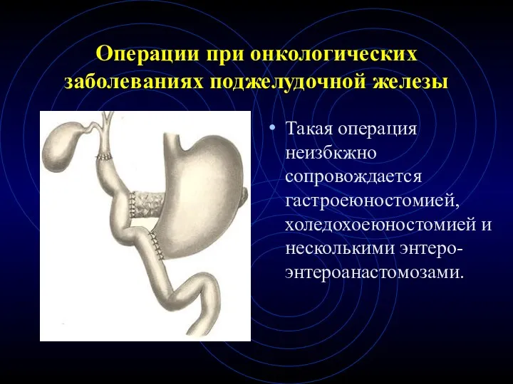 Операции при онкологических заболеваниях поджелудочной железы Такая операция неизбкжно сопровождается гастроеюностомией, холедохоеюностомией и несколькими энтеро-энтероанастомозами.