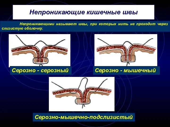 Непроникающие кишечные швы Серозно - серозный Серозно - мышечный Серозно-мышечно-подслизистый