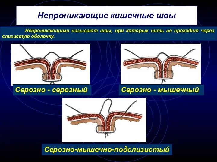 Непроникающие кишечные швы Серозно - серозный Серозно - мышечный Серозно-мышечно-подслизистый Непроникающими называют швы,