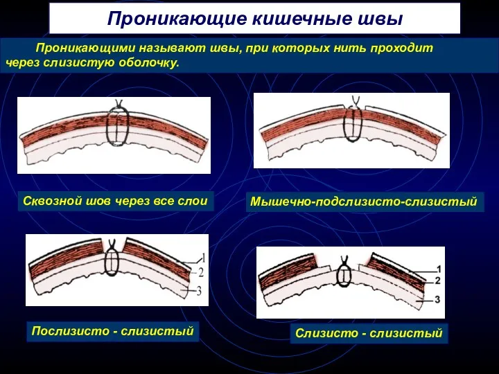 Проникающие кишечные швы Проникающими называют швы, при которых нить проходит через слизистую оболочку.