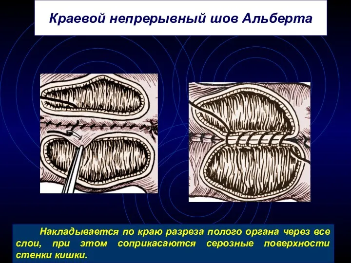 Краевой непрерывный шов Альберта Накладывается по краю разреза полого органа через все слои,