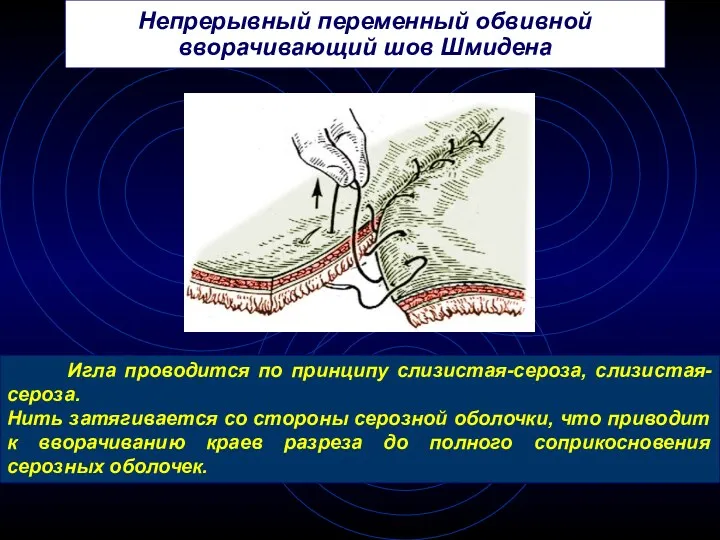 Непрерывный переменный обвивной вворачивающий шов Шмидена Игла проводится по принципу слизистая-сероза, слизистая-сероза. Нить