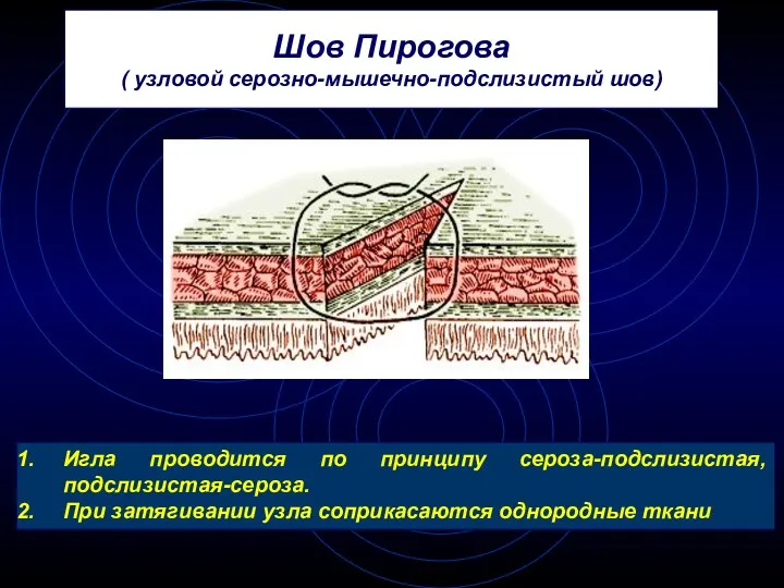 Шов Пирогова ( узловой серозно-мышечно-подслизистый шов) Игла проводится по принципу