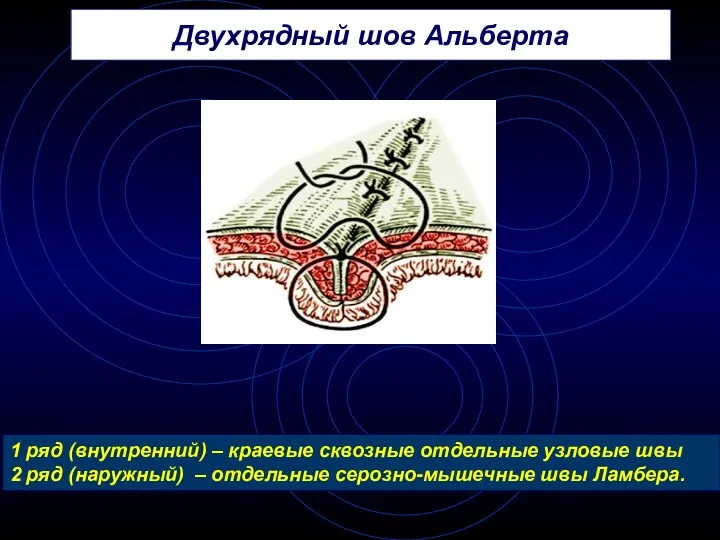 Двухрядный шов Альберта 1 ряд (внутренний) – краевые сквозные отдельные узловые швы 2