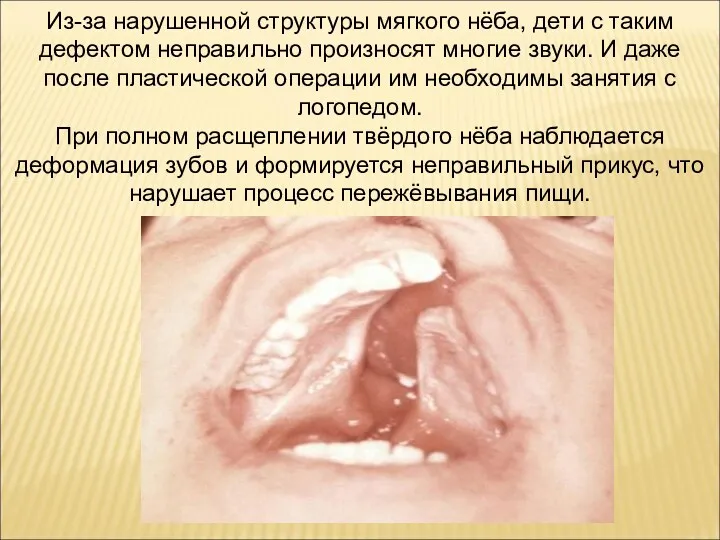 Из-за нарушенной структуры мягкого нёба, дети с таким дефектом неправильно произносят многие звуки.