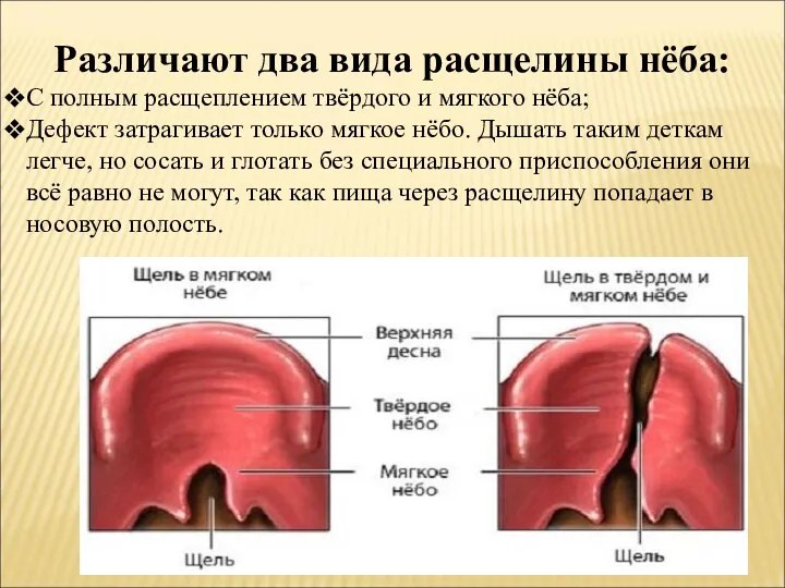 Различают два вида расщелины нёба: С полным расщеплением твёрдого и мягкого нёба; Дефект