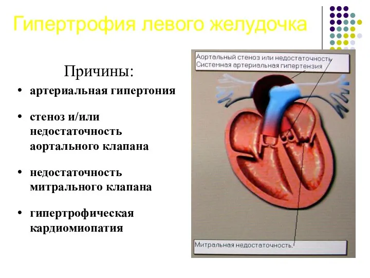 Гипертрофия левого желудочка Причины: артериальная гипертония стеноз и/или недостаточность аортального клапана недостаточность митрального клапана гипертрофическая кардиомиопатия