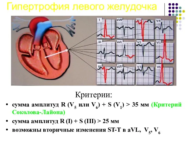 Гипертрофия левого желудочка Критерии: сумма амплитуд R (V5 или V6)