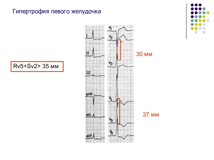 Гипертрофия левого желудочка 30 мм 37 мм Rv5+Sv2> 35 мм