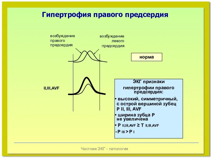 Частная ЭКГ - патология возбуждение правого предсердия возбуждение левого предсердия II,III,AVF норма ЭКГ