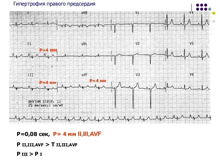Гипертрофия правого предсердия Р=0,08 сек, Р= 4 мм II,III,AVF Р