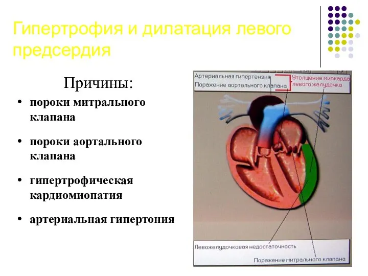 Гипертрофия и дилатация левого предсердия Причины: пороки митрального клапана пороки аортального клапана гипертрофическая кардиомиопатия артериальная гипертония