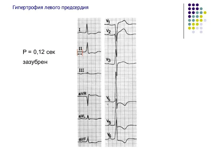 Гипертрофия левого предсердия Р = 0,12 сек зазубрен