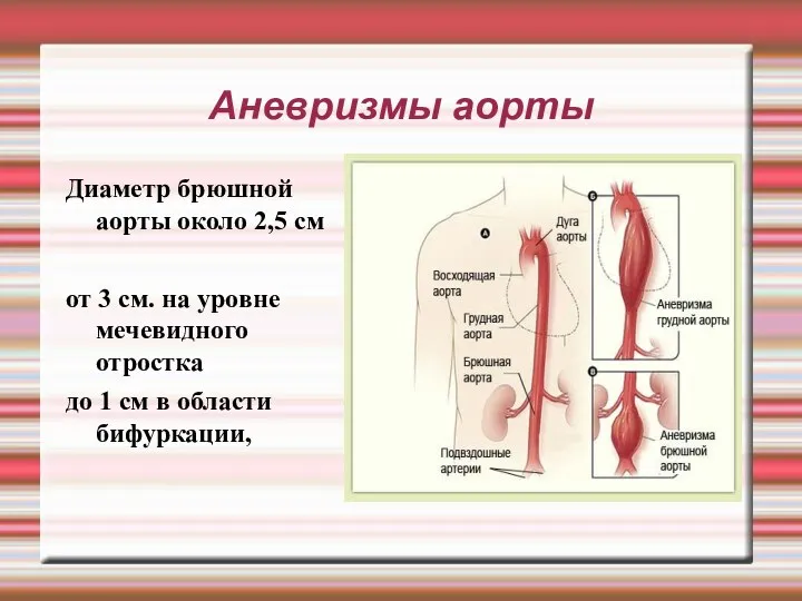 Аневризмы аорты Диаметр брюшной аорты около 2,5 см от 3