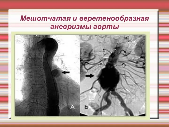 Мешотчатая и веретенообразная аневризмы аорты