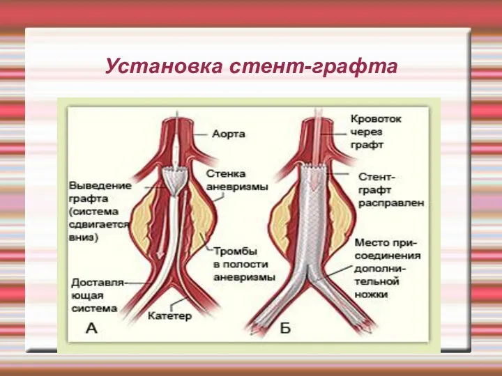 Установка стент-графта