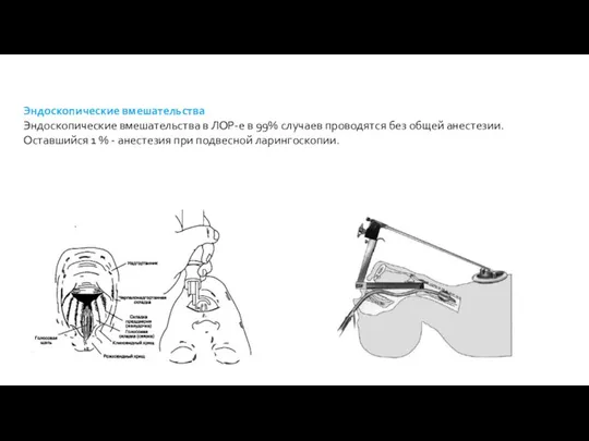 Эндоскопические вмешательства Эндоскопические вмешательства в ЛОР-е в 99% случаев проводятся