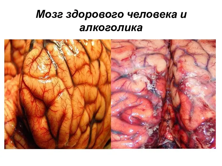 Мозг здорового человека и алкоголика