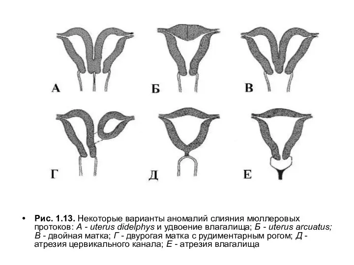 Рис. 1.13. Некоторые варианты аномалий слияния мюллеровых протоков: А -