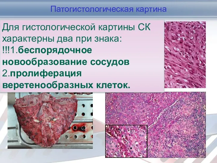 Патогистологическая картина Гістологічно саркома Капоші – судинна пухлина, що складається