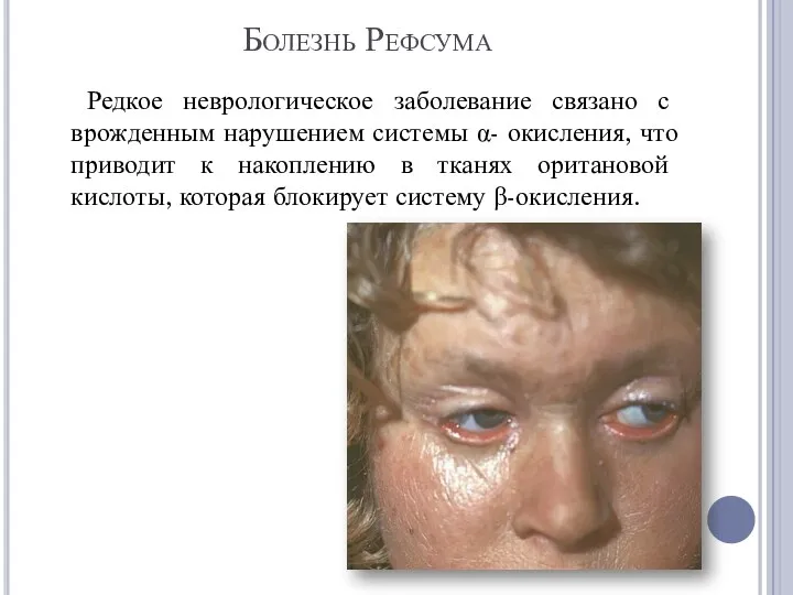 Болезнь Рефсума Редкое неврологическое заболевание связано с врожденным нарушением системы