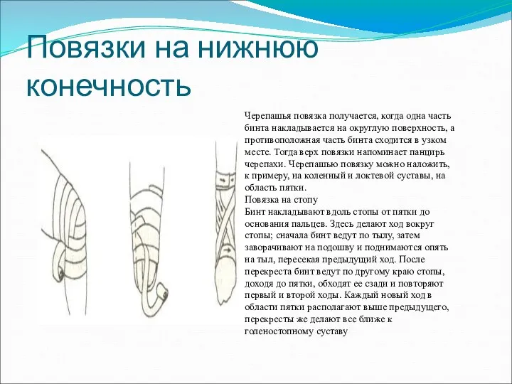 Повязки на нижнюю конечность Черепашья повязка получается, когда одна часть