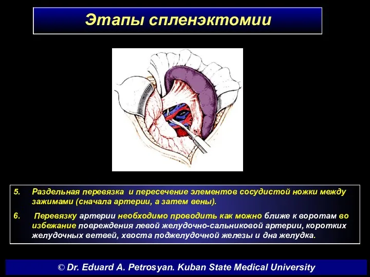 Этапы спленэктомии 5. Раздельная перевязка и пересечение элементов сосудистой ножки