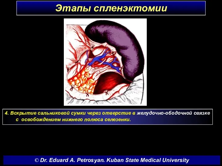 Этапы спленэктомии 4. Вскрытие сальниковой сумки через отверстие в желудочно-ободочной