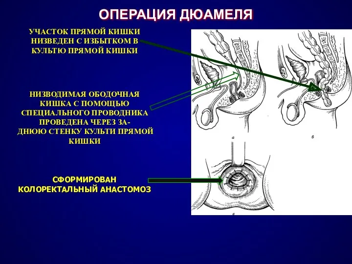 СФОРМИРОВАН КОЛОРЕКТАЛЬНЫЙ АНАСТОМОЗ НИЗВОДИМАЯ ОБОДОЧНАЯ КИШКА С ПОМОЩЬЮ СПЕЦИАЛЬНОГО ПРОВОДНИКА