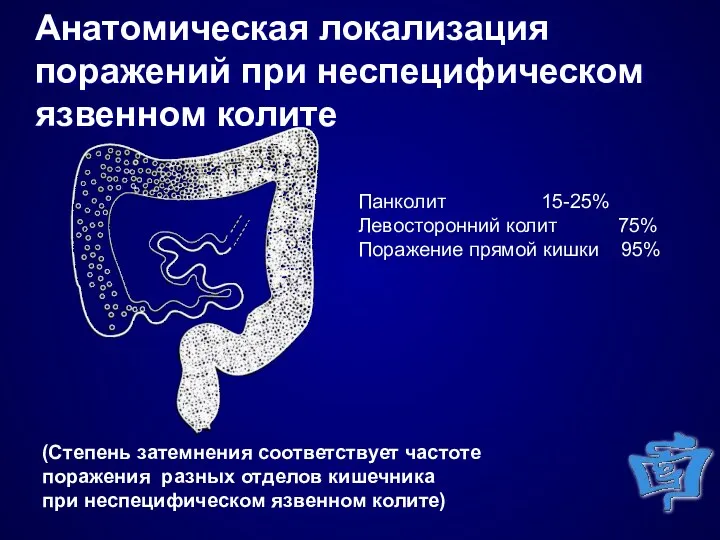 Анатомическая локализация поражений при неспецифическом язвенном колите Панколит 15-25% Левосторонний