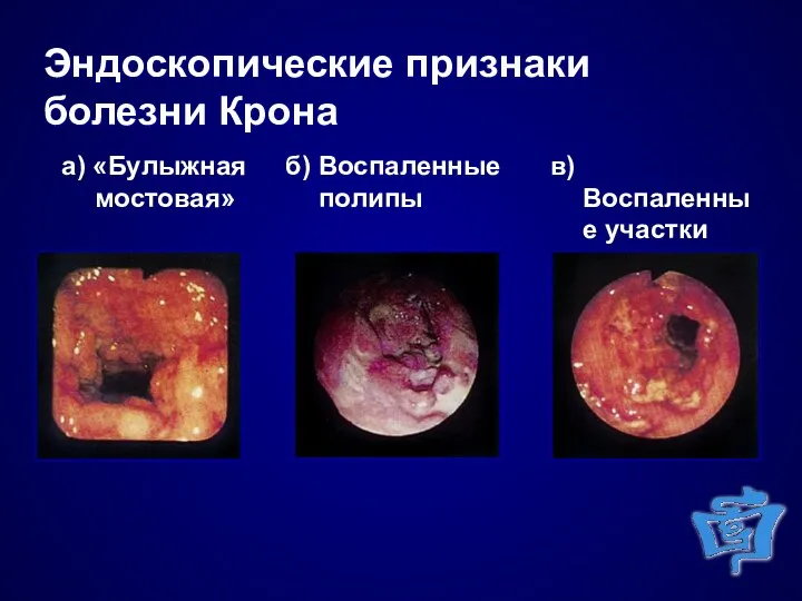 Эндоскопические признаки болезни Крона а) «Булыжная мостовая» б) Воспаленные полипы в) Воспаленные участки слизистой