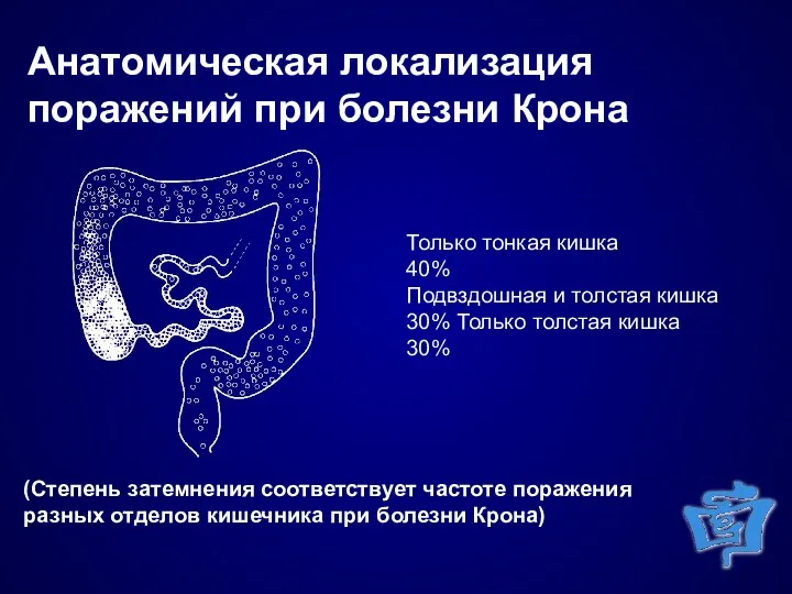 Анатомическая локализация поражений при болезни Крона Только тонкая кишка 40%