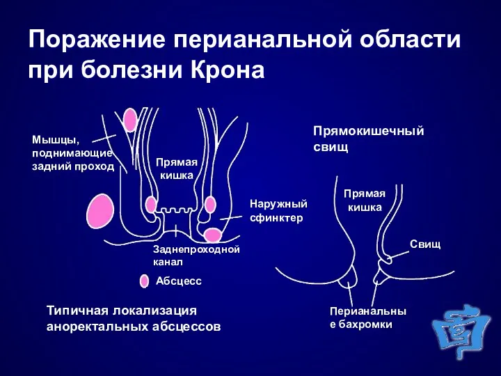 Поражение перианальной области при болезни Крона Типичная локализация аноректальных абсцессов