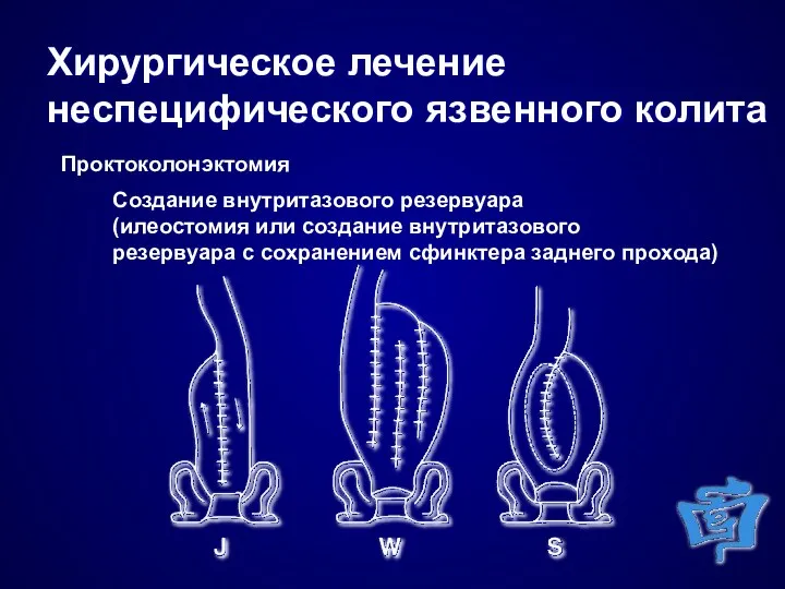 Хирургическое лечение неспецифического язвенного колита Проктоколонэктомия Создание внутритазового резервуара (илеостомия