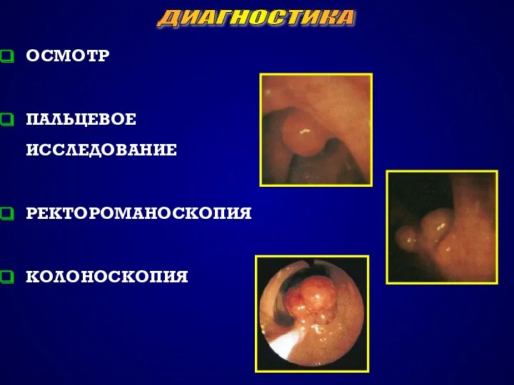 ДИАГНОСТИКА ОСМОТР ПАЛЬЦЕВОЕ ИССЛЕДОВАНИЕ РЕКТОРОМАНОСКОПИЯ КОЛОНОСКОПИЯ