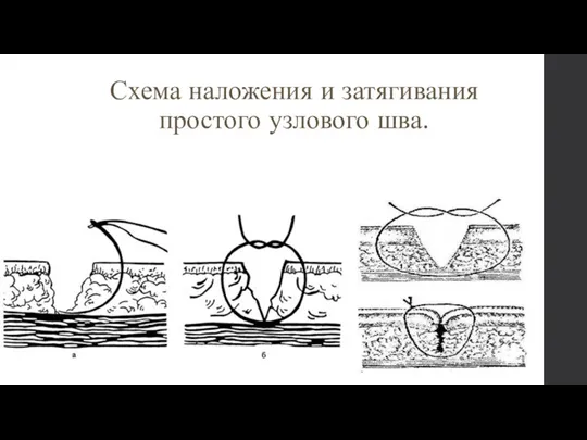 Схема наложения и затягивания простого узлового шва.