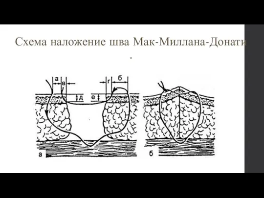 Схема наложение шва Мак-Миллана-Донати .