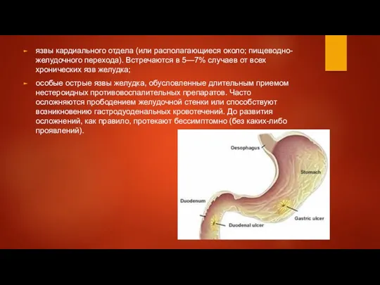 язвы кардиального отдела (или располагающиеся около; пищеводно-желудочного перехода). Встречаются в