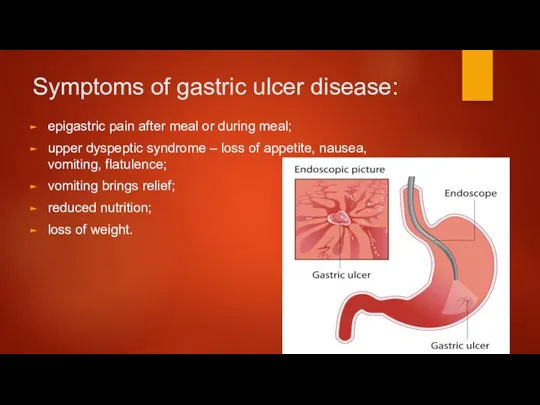 Symptoms of gastric ulcer disease: epigastric pain after meal or