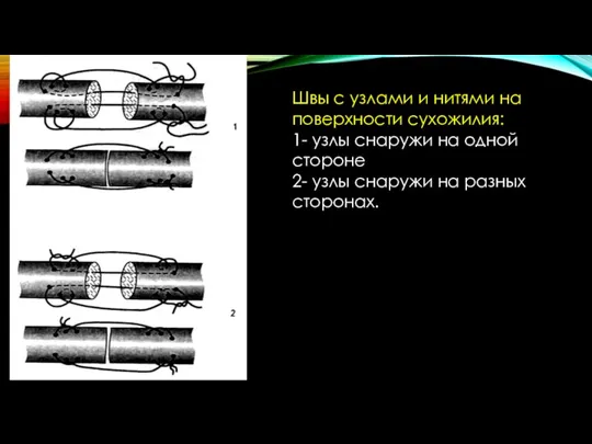 Швы с узлами и нитями на поверхности сухожилия: 1- узлы