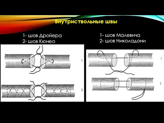 1- шов Дройера 2- шов Кюнео 1- шов Малевича 2- шов Николадони Внутриствольные швы