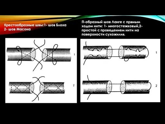 П-образный шов Ланге с прямым ходом нити: 1- многостежковый,2- простой