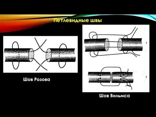 Петлевидные швы Шов Розова Шов Вильмса