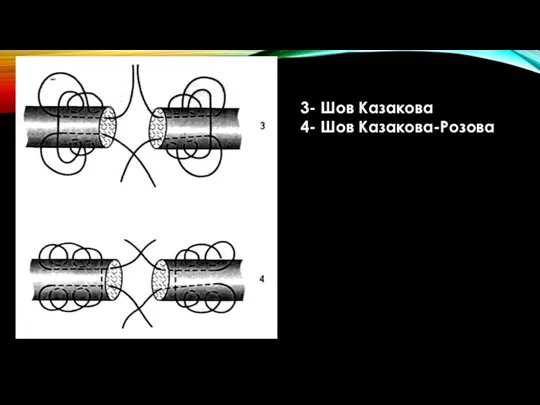 3- Шов Казакова 4- Шов Казакова-Розова