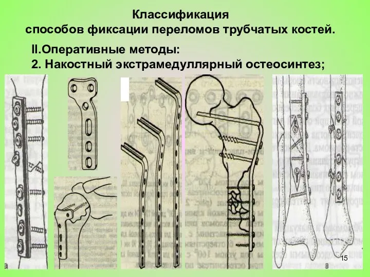 II.Оперативные методы: 2. Накостный экстрамедуллярный остеосинтез; Классификация способов фиксации переломов трубчатых костей.