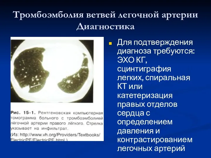 Тромбоэмболия ветвей легочной артерии Диагностика Для подтверждения диагноза требуются: ЭХО