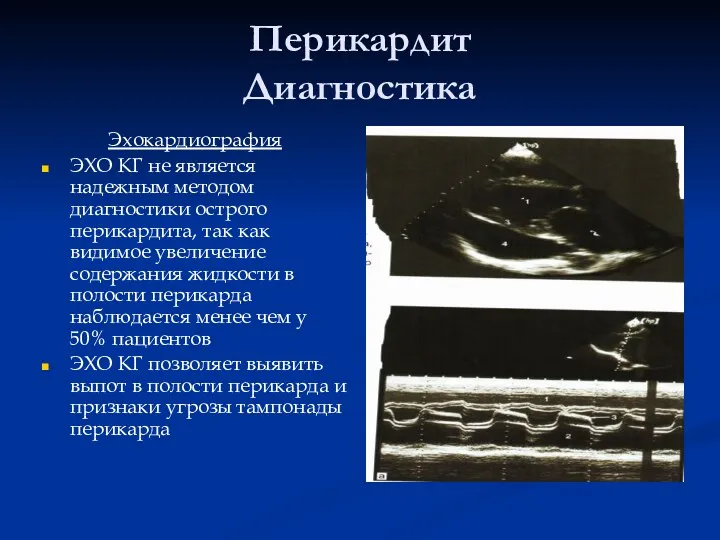 Перикардит Диагностика Эхокардиография ЭХО КГ не является надежным методом диагностики