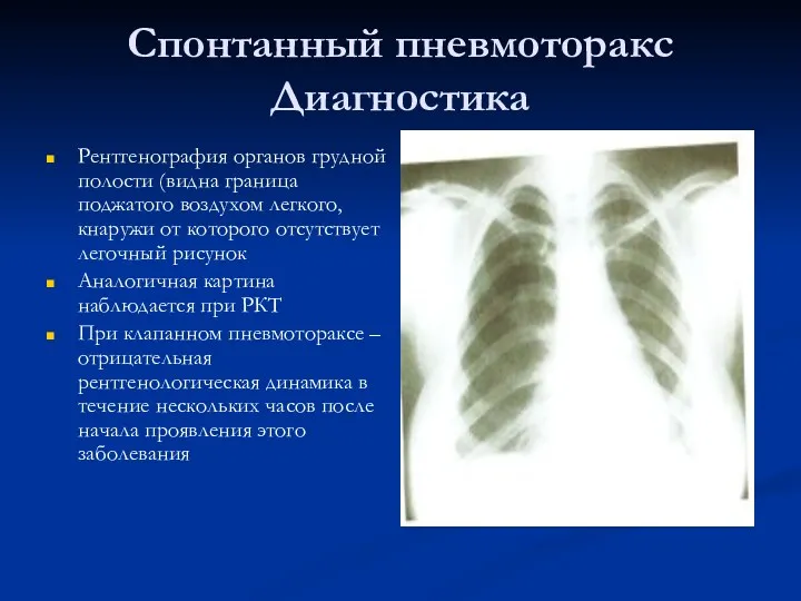 Спонтанный пневмоторакс Диагностика Рентгенография органов грудной полости (видна граница поджатого