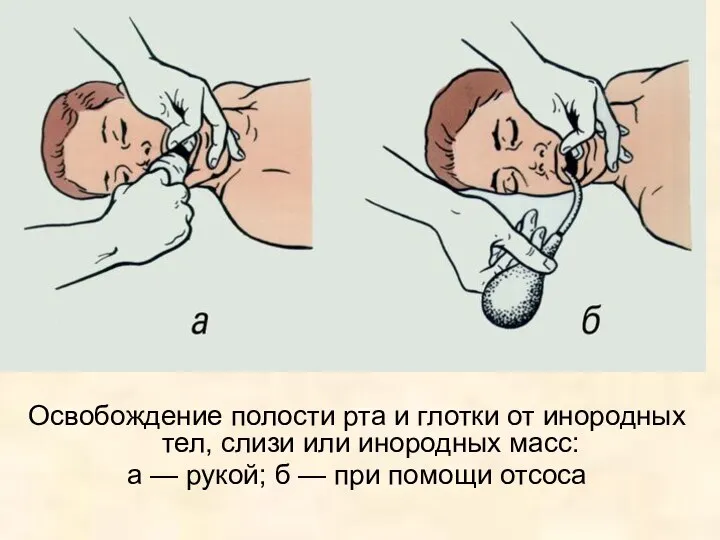 Освобождение полости рта и глотки от инородных тел, слизи или